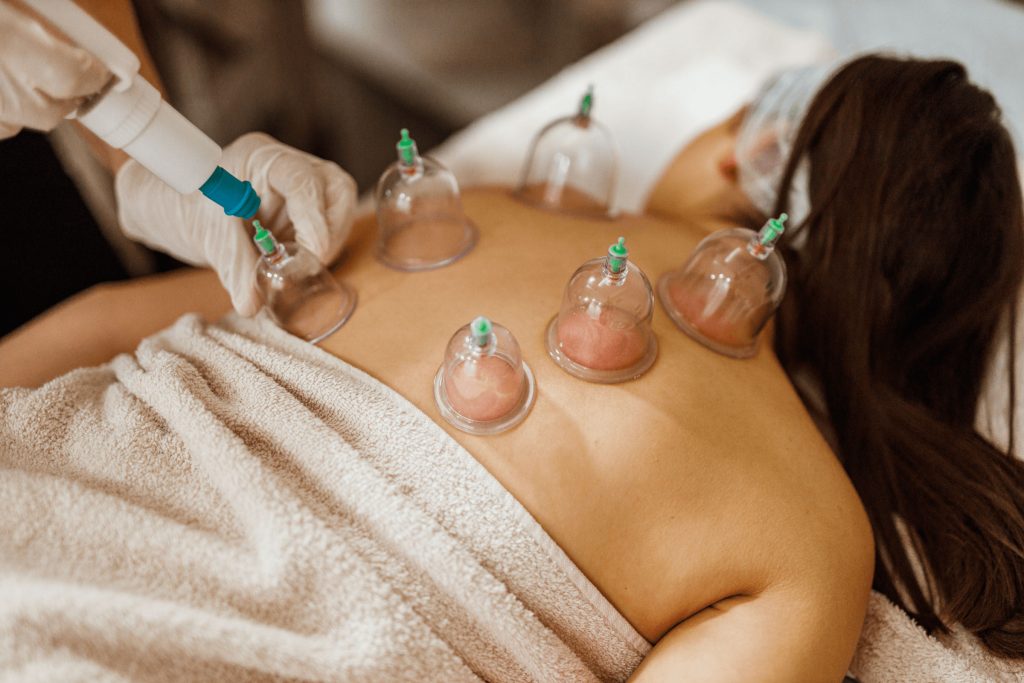 chinese tcm cupping treatment toronto