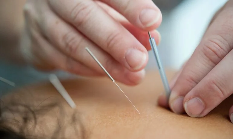 best toronto acupuncture with tiny needles and no pain